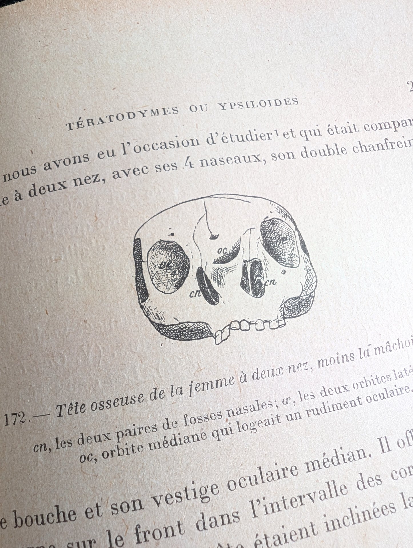 Livre 1927 Traité de Tératologie (252 figures de monstres et malformations)
