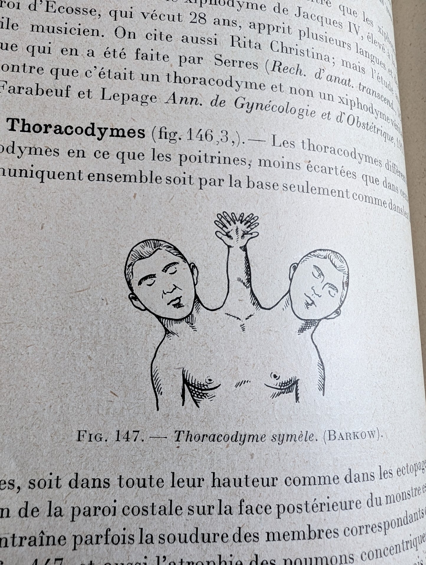 Livre 1927 Traité de Tératologie (252 figures de monstres et malformations)