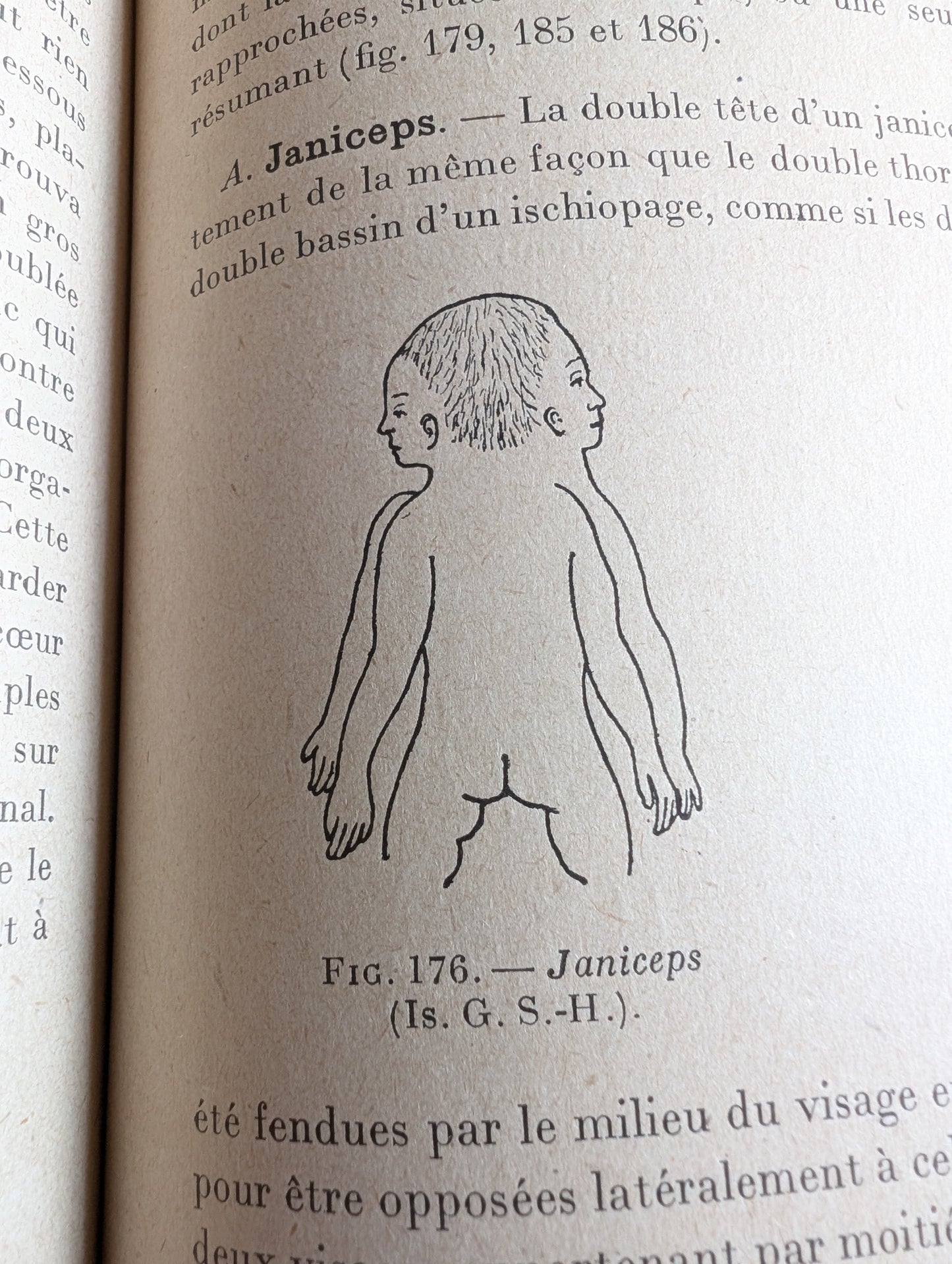 Livre 1927 Traité de Tératologie (252 figures de monstres et malformations)