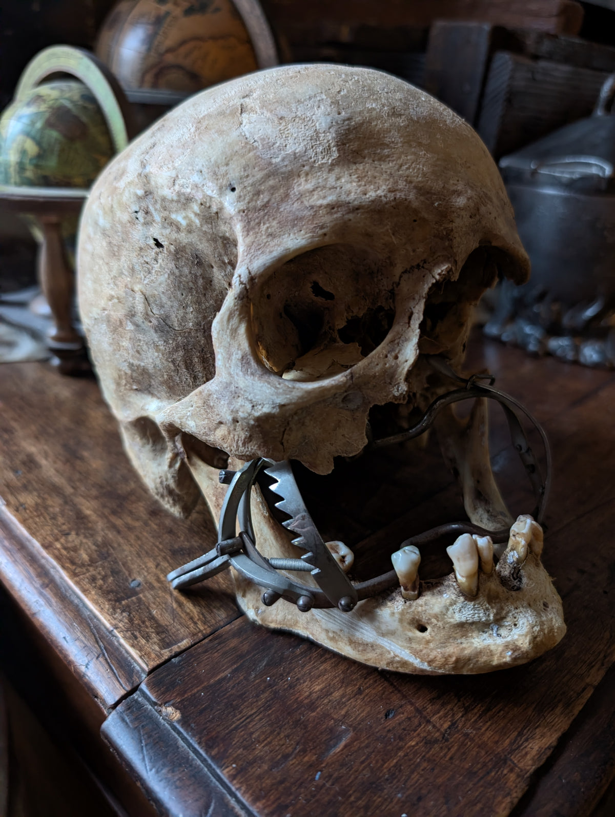 Antique Male Skull with Vintage Medical Mouth Opener – Anatomical Curiosity, early 20th century from Germany