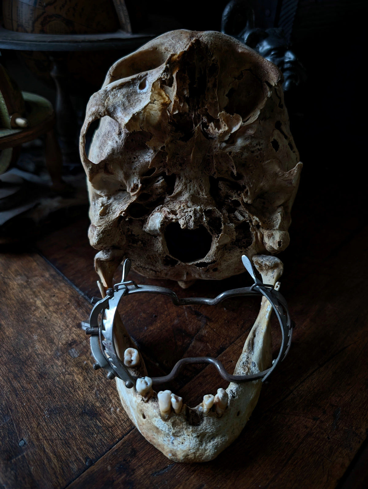 Antique Male Skull with Vintage Medical Mouth Opener – Anatomical Curiosity, early 20th century from Germany