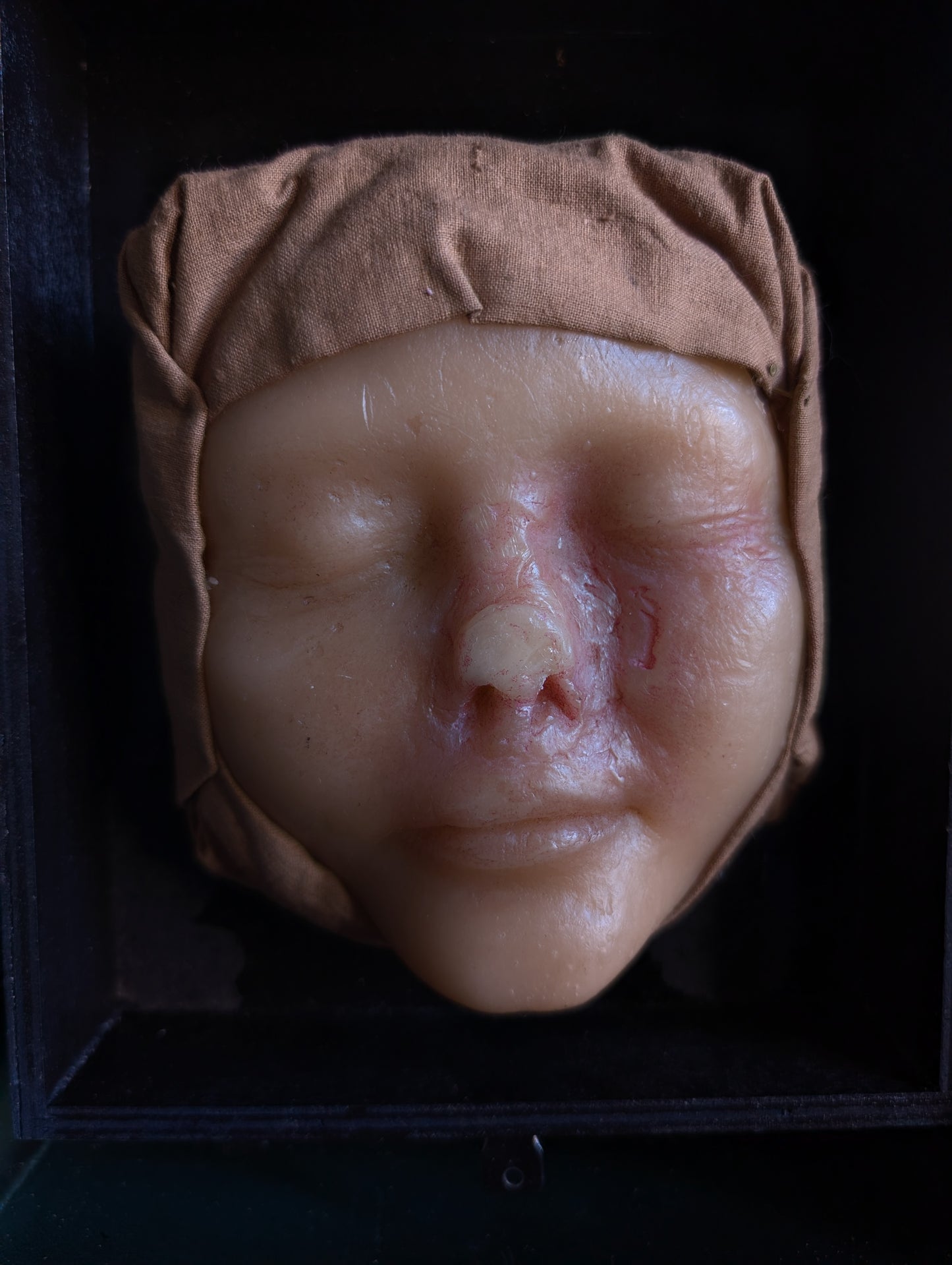 Vintage Medical Wax Moulage – Post-Mortem Study of a Woman Following Nasal Necrosis (Post Mortem)